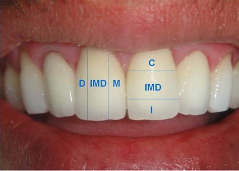 Dentes E Slots